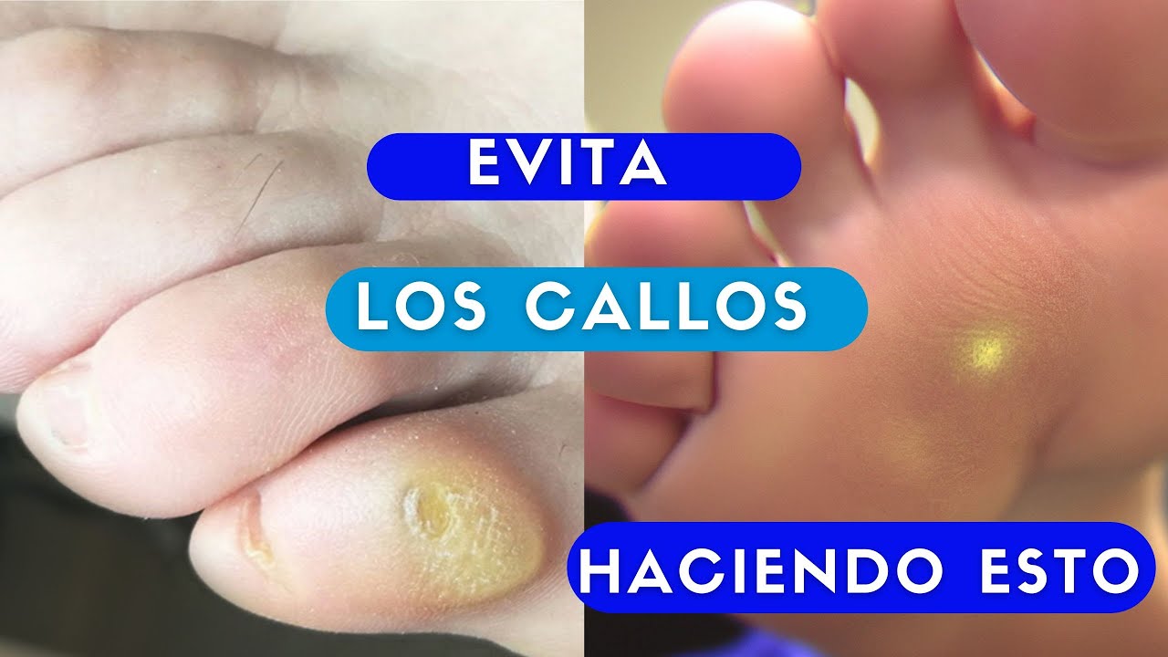como evitar que salgan callos en los pies