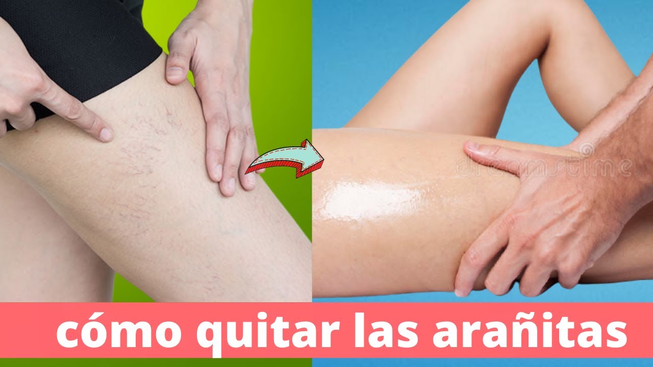 como prevenir las varices y arañitas en las piernas