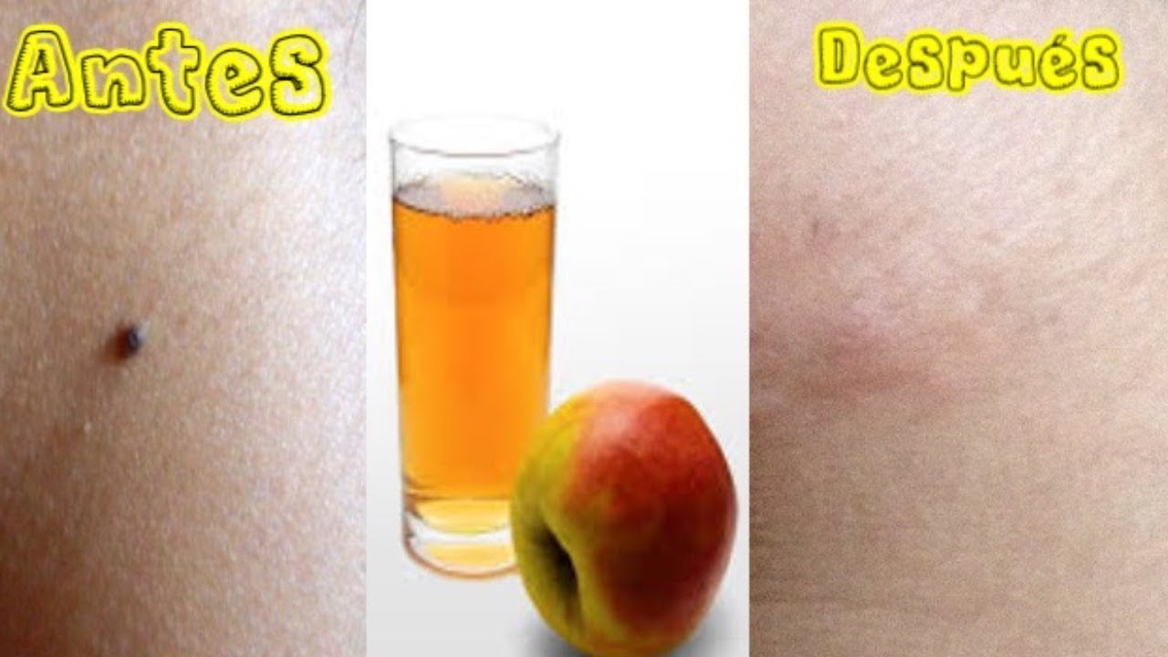 como quitar verrugas con vinagre de sidra de manzana