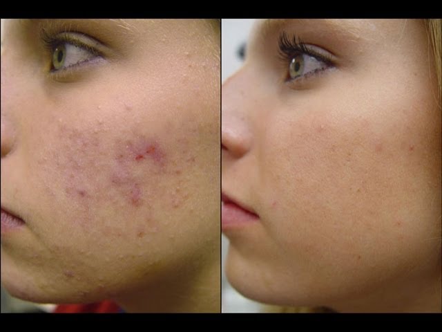 mascarilla para granos y espinillas en la cara