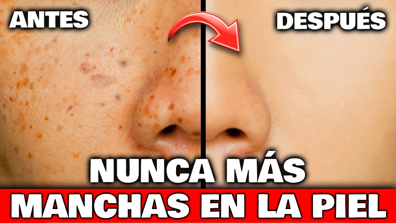 mascarillas caseras para las espinillas y manchas en la cara