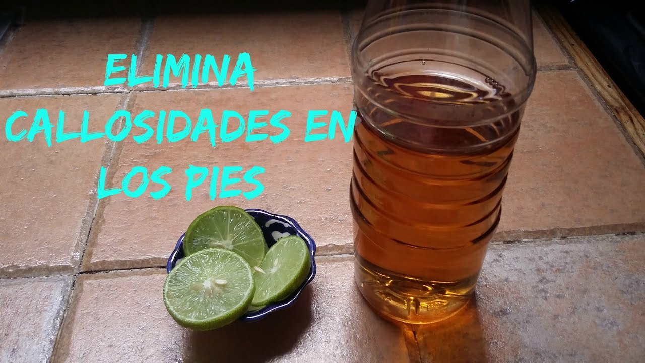 remedios caseros para un callo en el pie