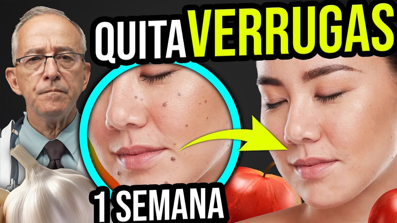 como acabar con las verrugas de forma natural