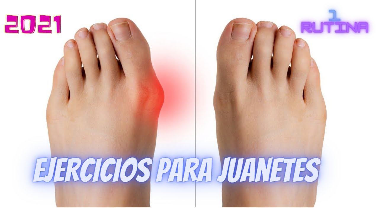 como eliminar los juanetes de los dedos delos pies
