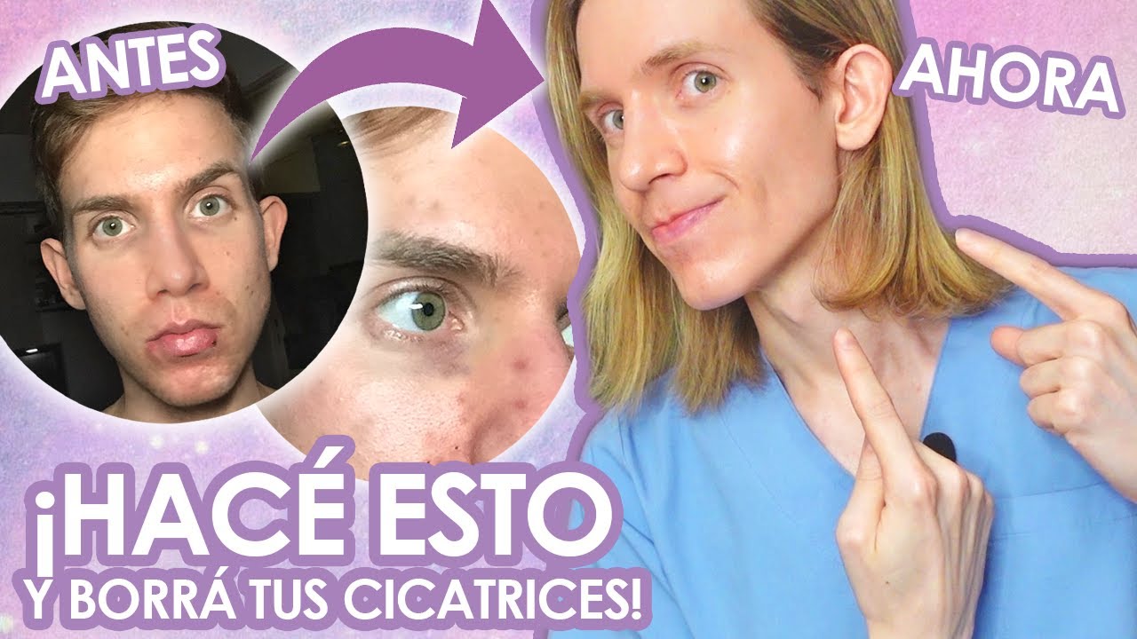 como me puedo quitar las cicatrices del acne