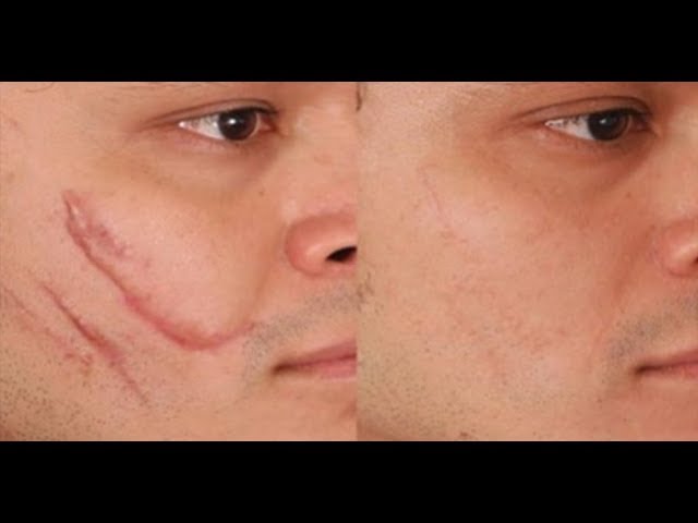 como quitar cicatrices en la cara con remedios caseros
