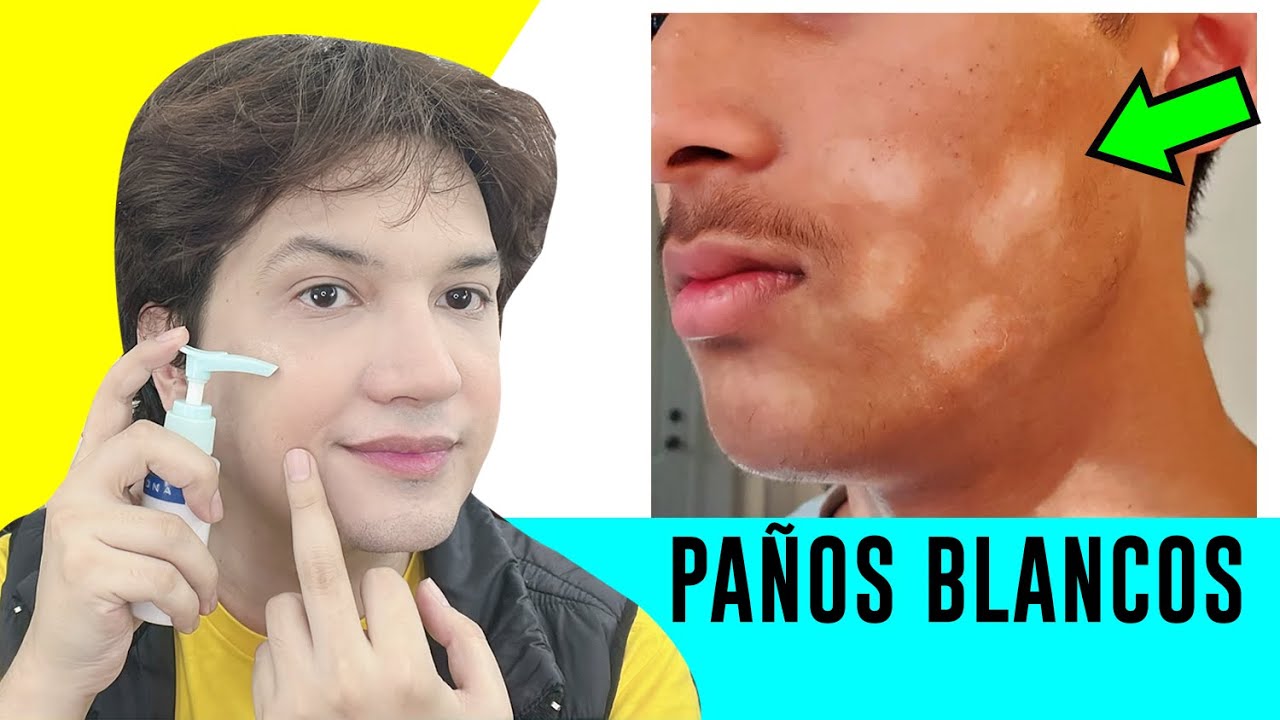 como quitar las manchas blancas dela cara rapido naturalmente