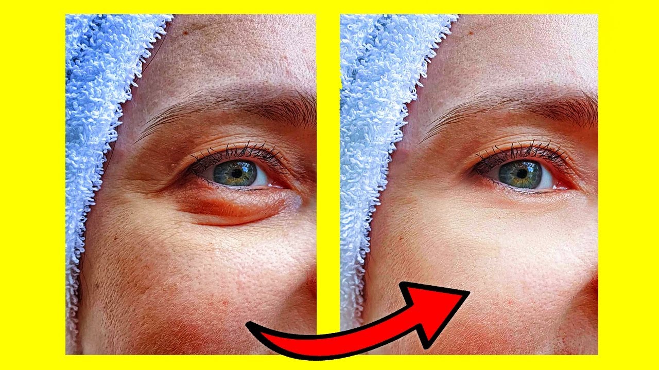 como quitar las ojeras y bolsas delos ojos remedios caseros