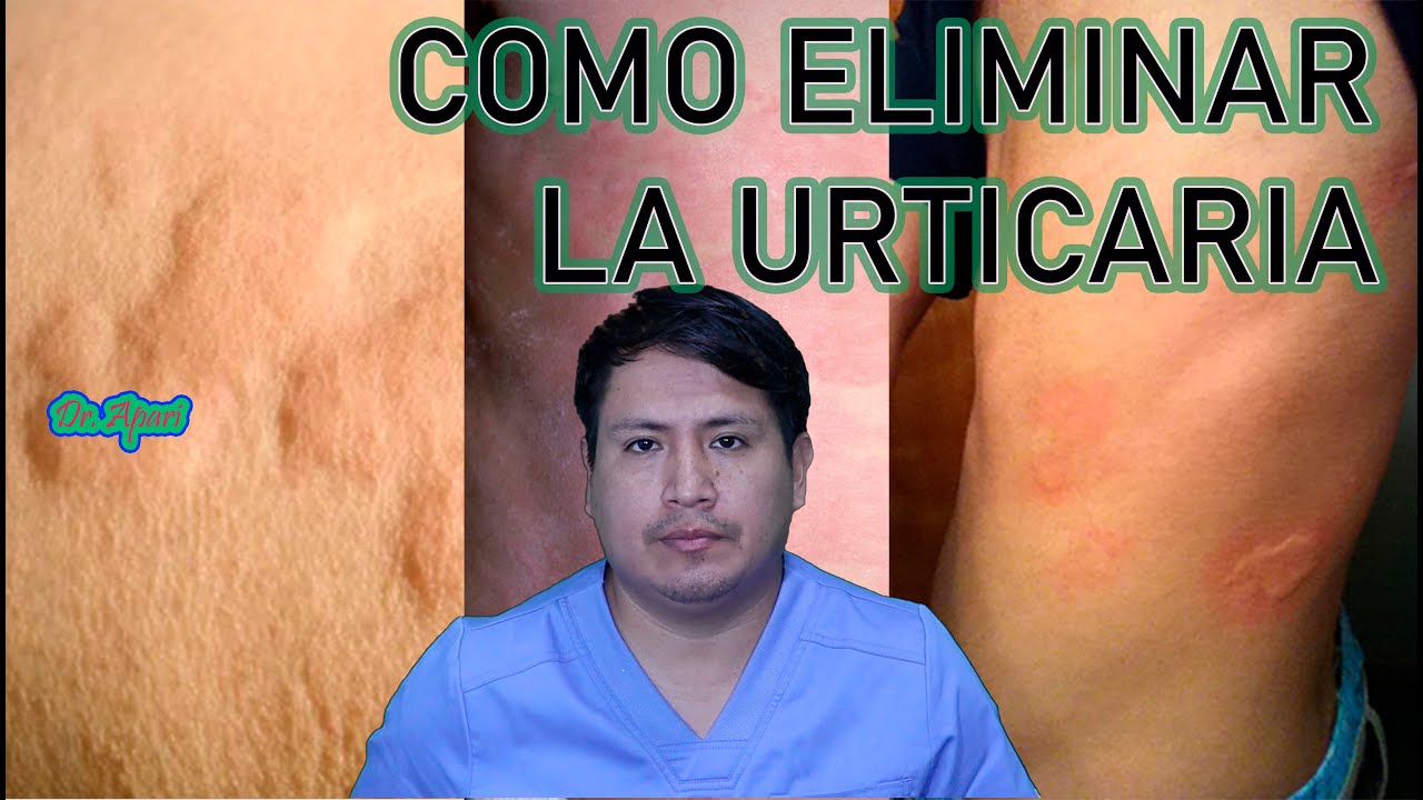 como se quitan las ronchas de la piel