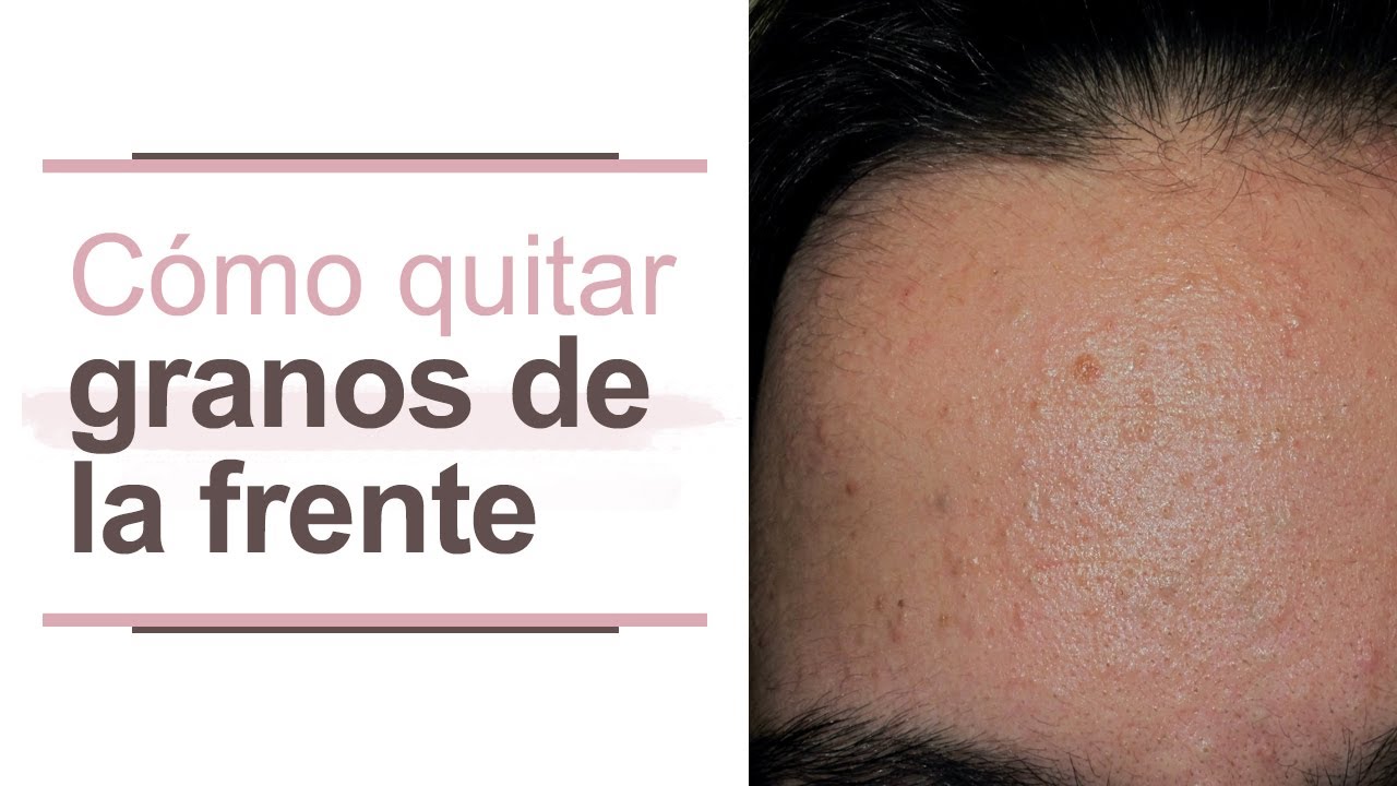 con que se quitan los granos de la cara