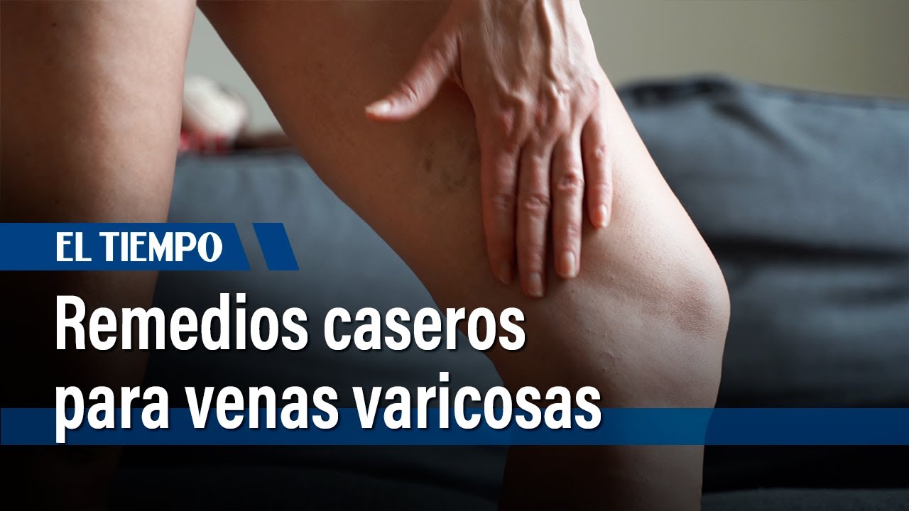 medicina natural para las varices en las piernas