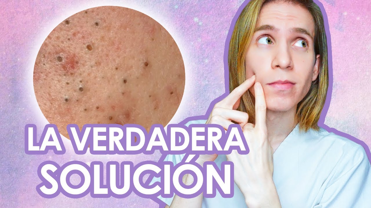 como me quito los puntos negros de la cara